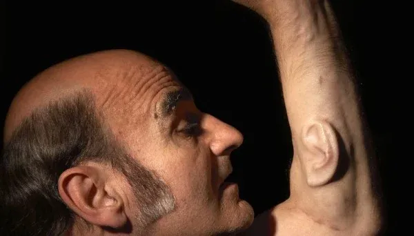 Extra Ear: Ear on Arm by Stelarc (2008). The ear is a permanent fixture on Stelarc’s arm, having integrated the biocompatible frame surgeons inserted under the skin into its own tissue and blood supply within six months.